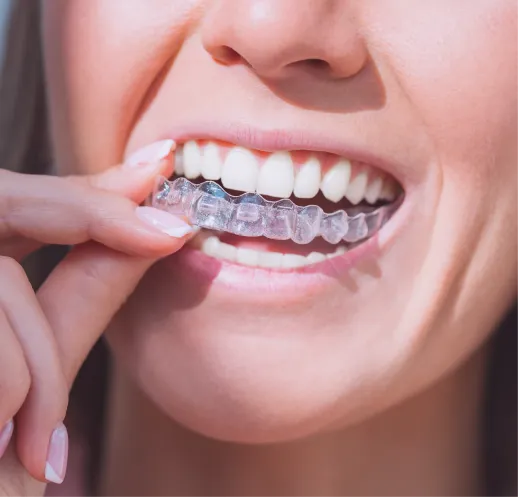 Invisalign