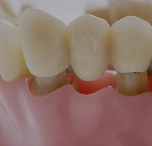 Dental Bridge