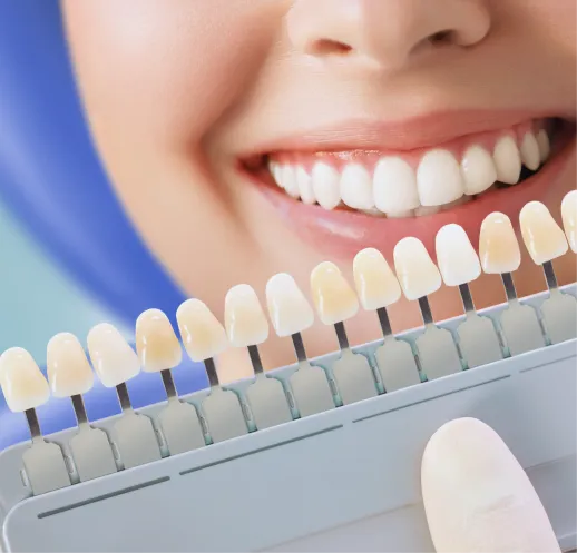 Dental Veneers